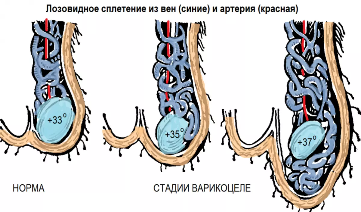 Вена левого яичка. Варикозное расширение вен семенного канатика III степени. Варикозное расширение вен семенного канатика II степени. Гроздевидное венозное сплетение.