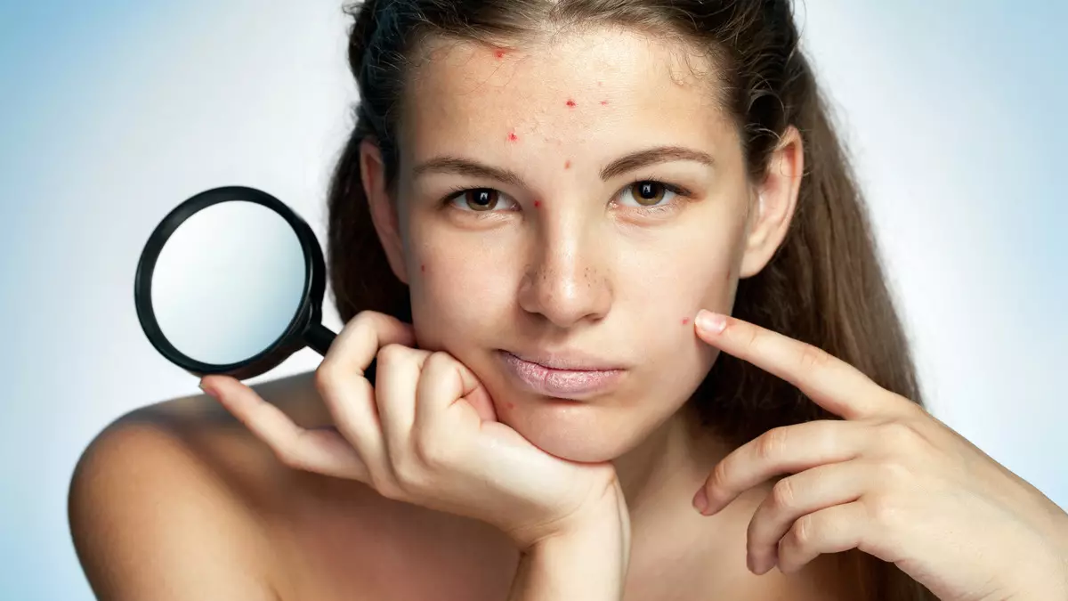 In de strijd voor schoonheid: gooi 7 gemeenschappelijke mythen over acne 40776_3