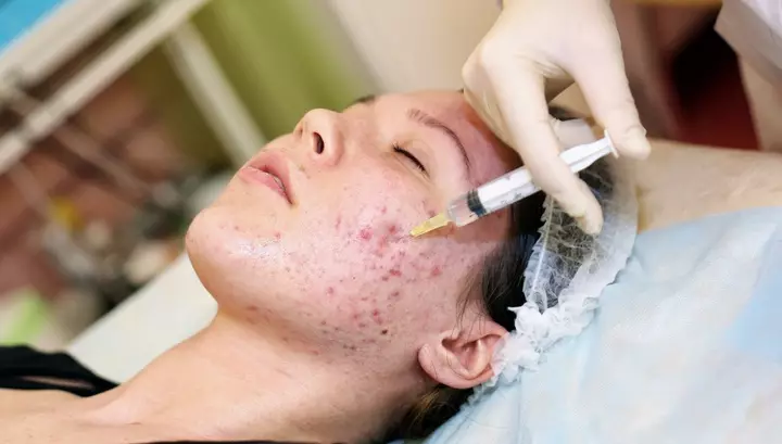 Nella lotta per la bellezza: lanciare 7 miti comuni sull'acne 40776_4